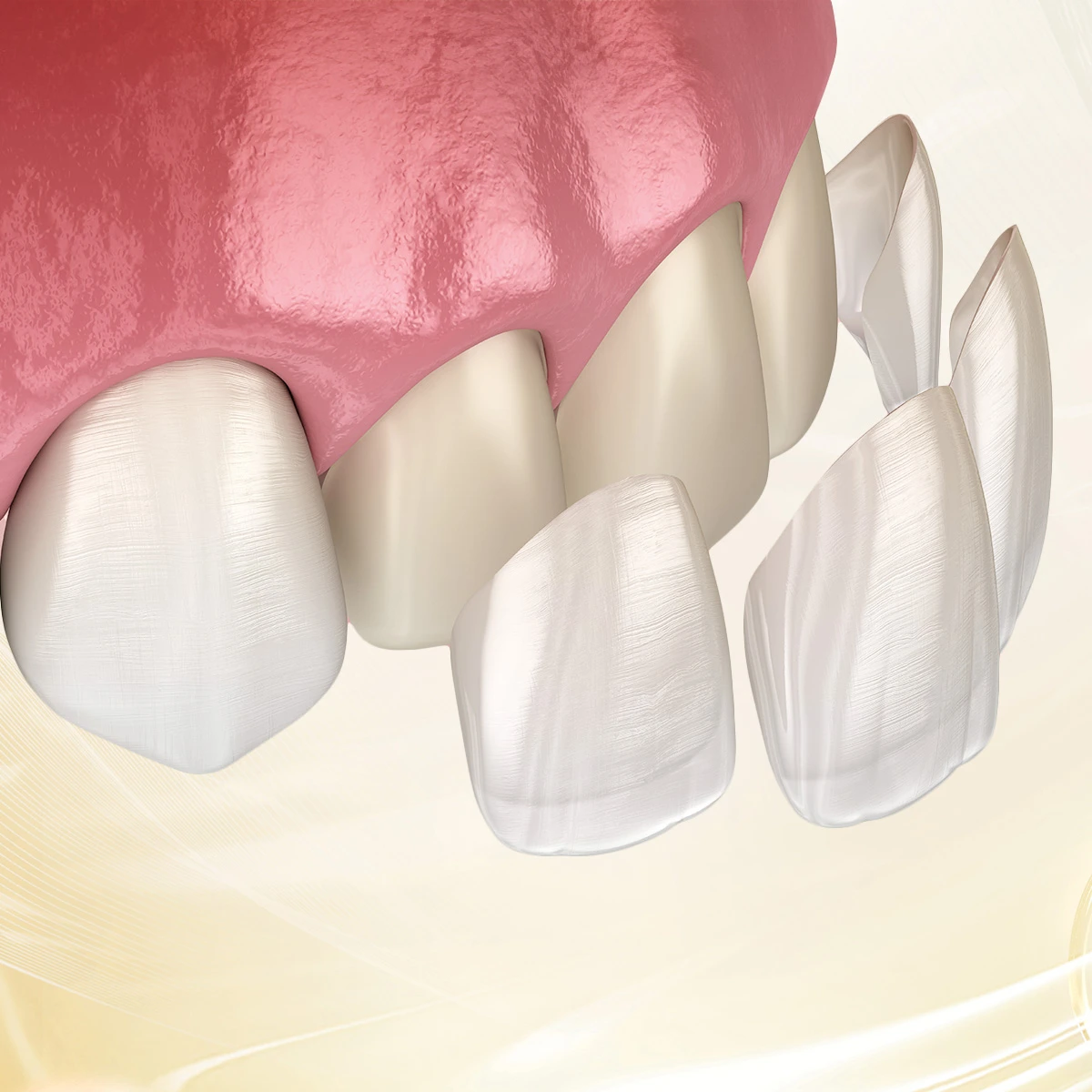 Dán Veneer là phương pháp bảo tồn tối đa răng thật